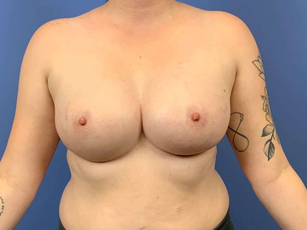 After Image: Patient 43890 - front