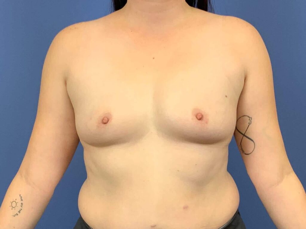 Before Image: Patient 43890 - front