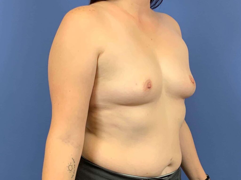 Before Image: Patient 43890 - front