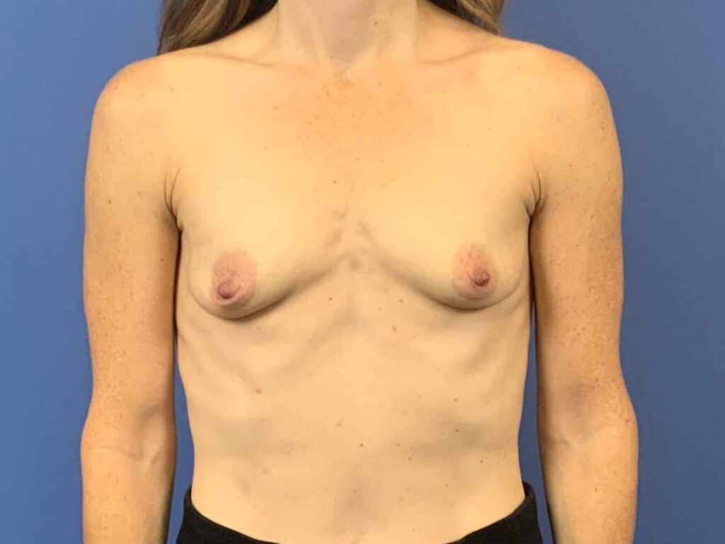 Before Image: Patient 44043 - front