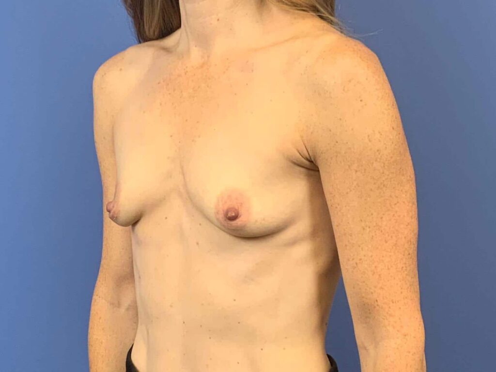 Before Image: Patient 44043 - left-front-oblique