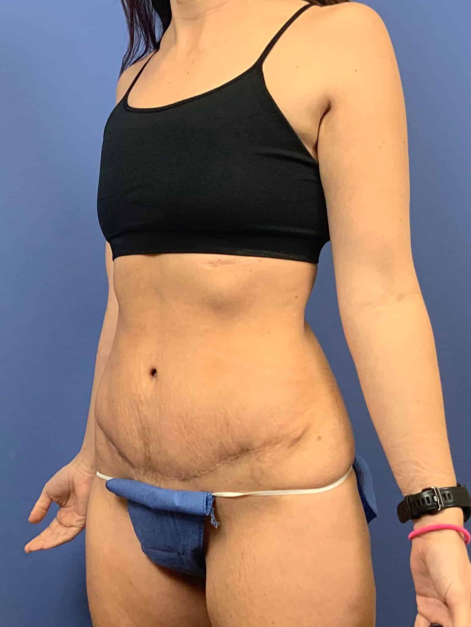 After Image: Patient 43938 - left-front-oblique