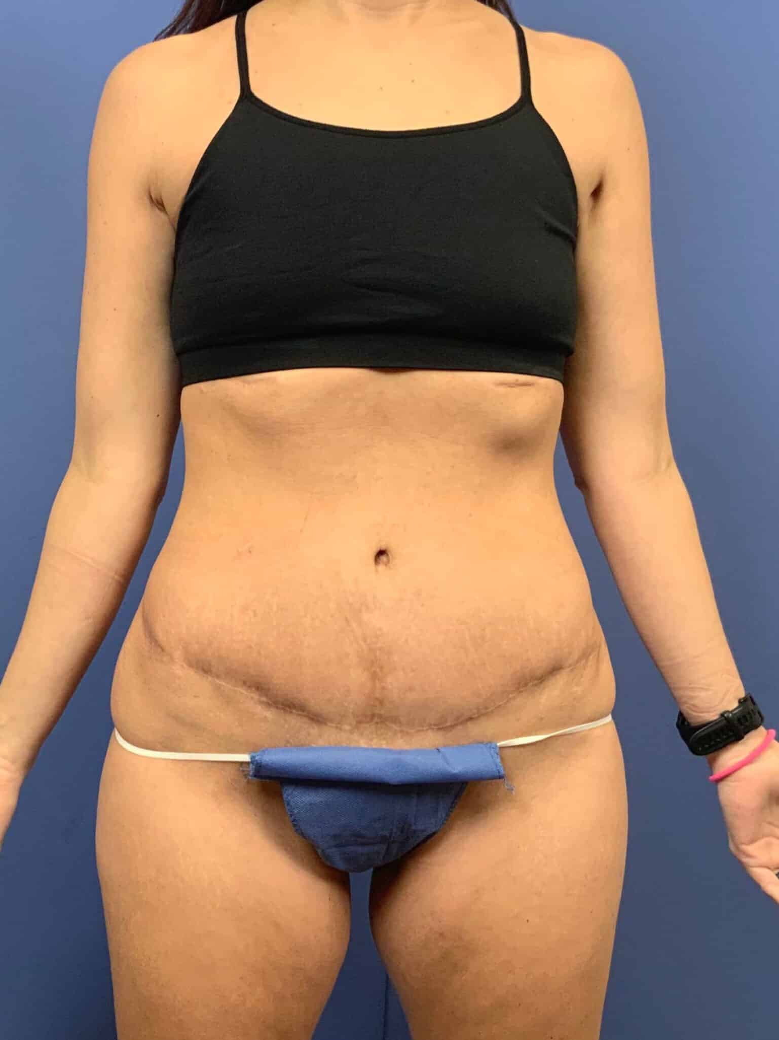 After Image: Patient 43938 - front
