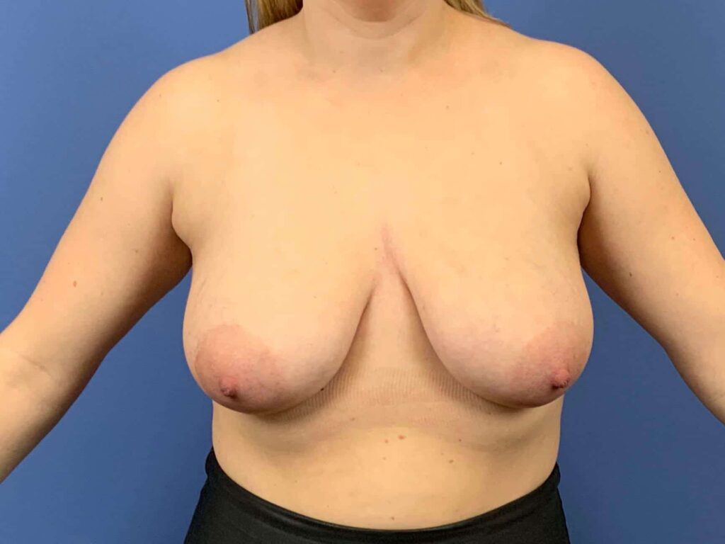 Before Image: Patient 43879 - front