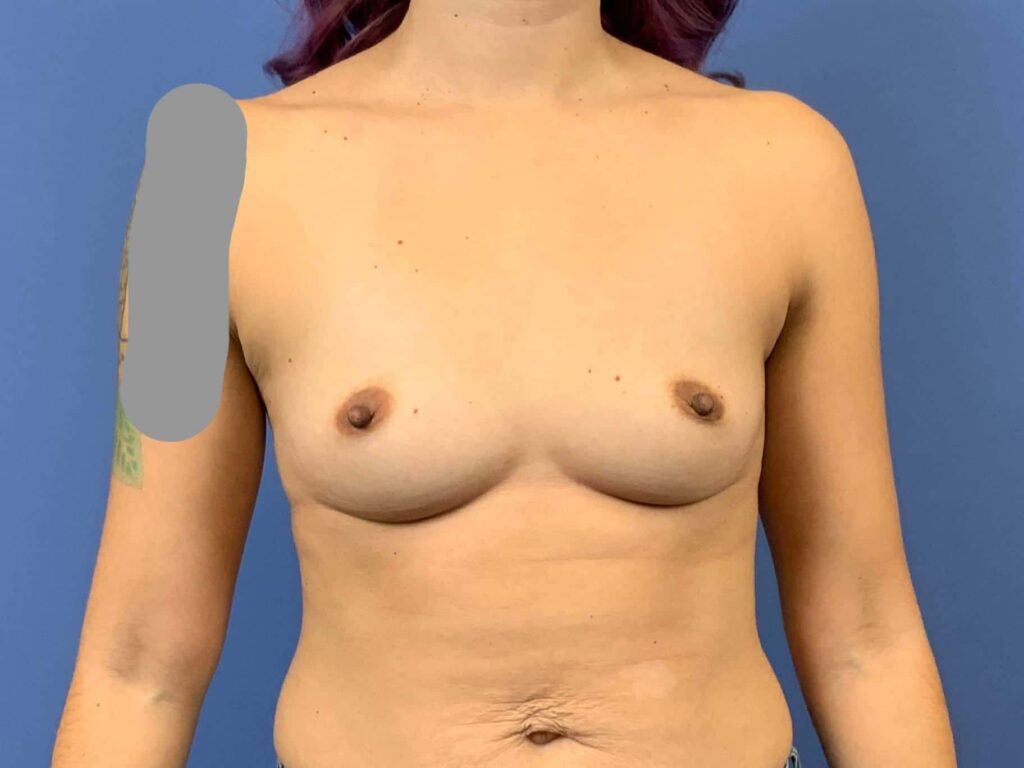 Before Image: Patient 43911 - front