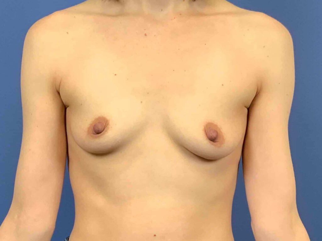 Before Image: Patient 43945 - front