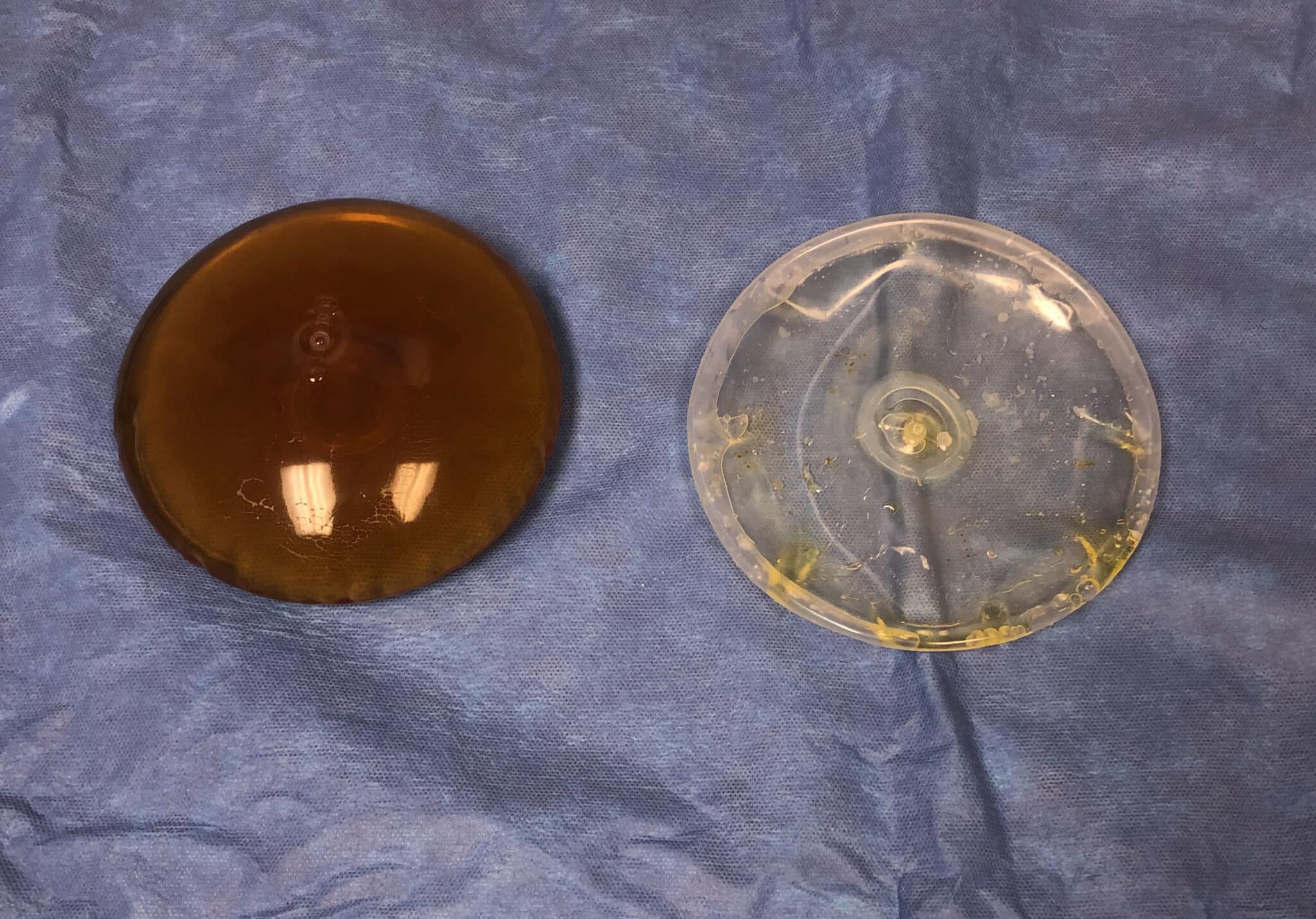 After Image: Patient 44003 - front