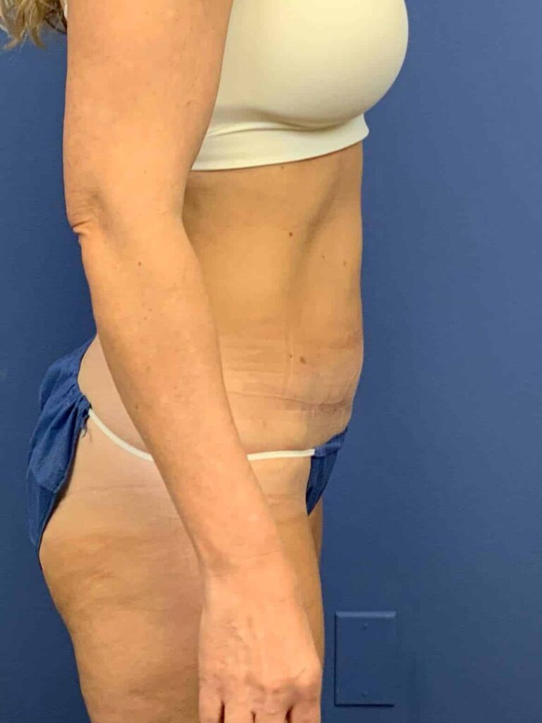 After Image:  - right-side