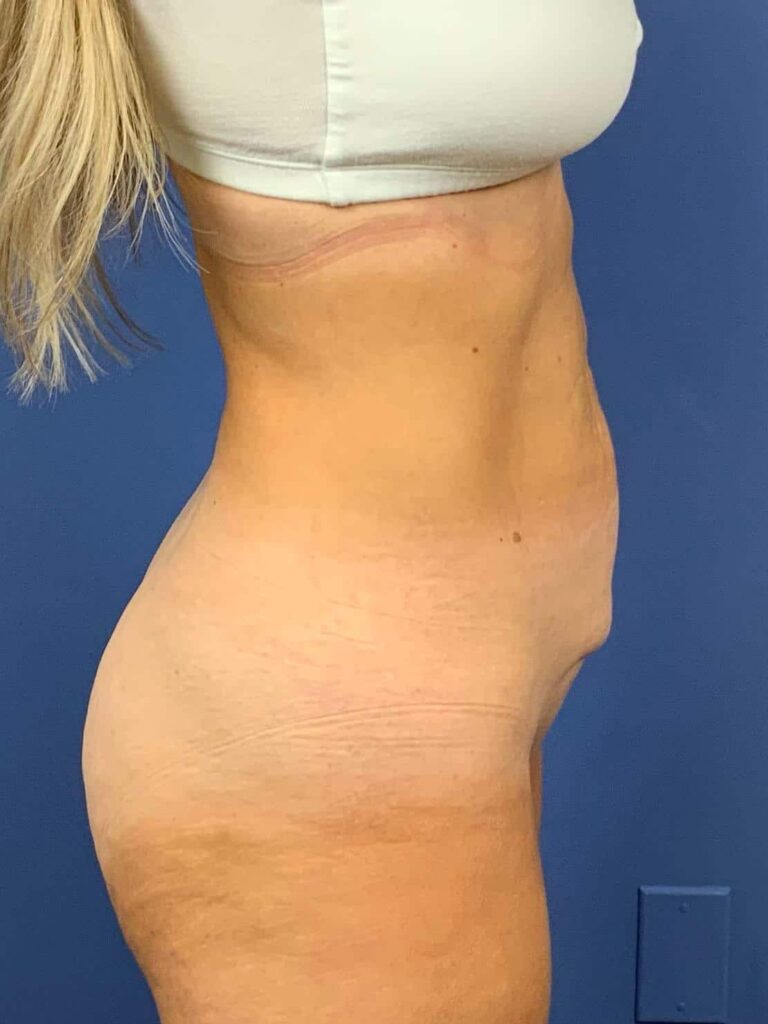 Before Image:  - right-side