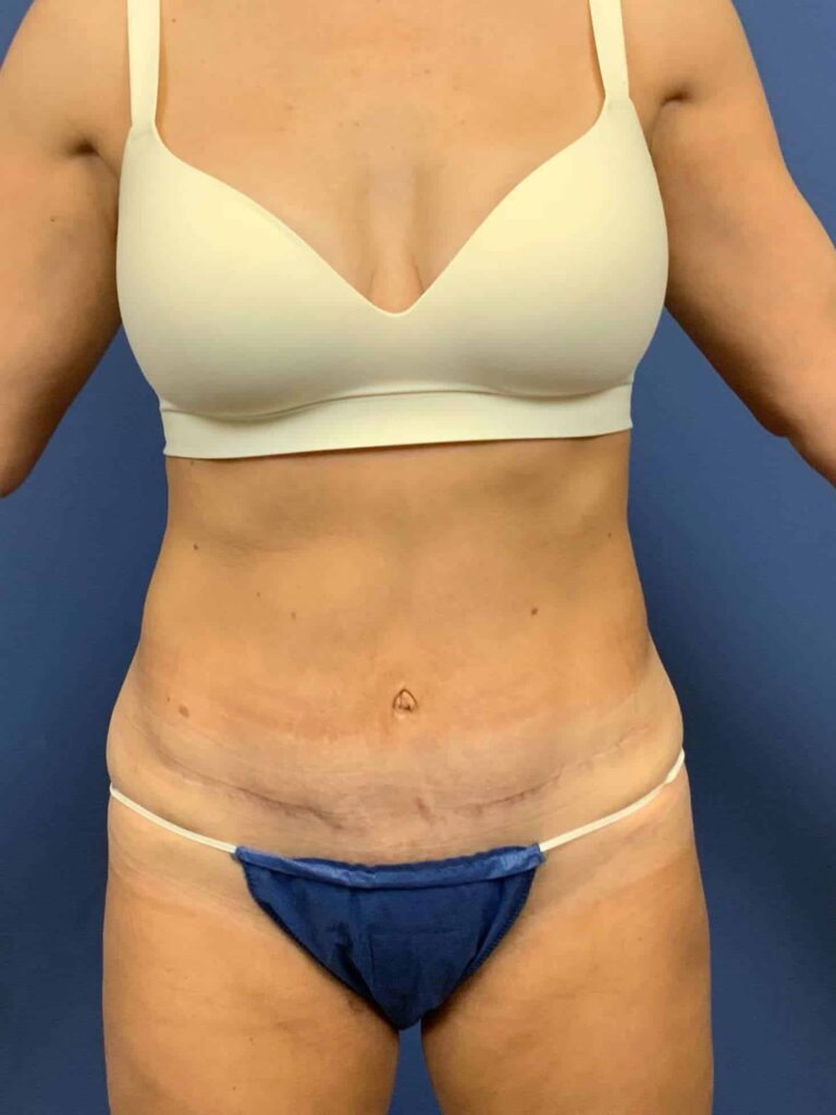 After Image:  - front
