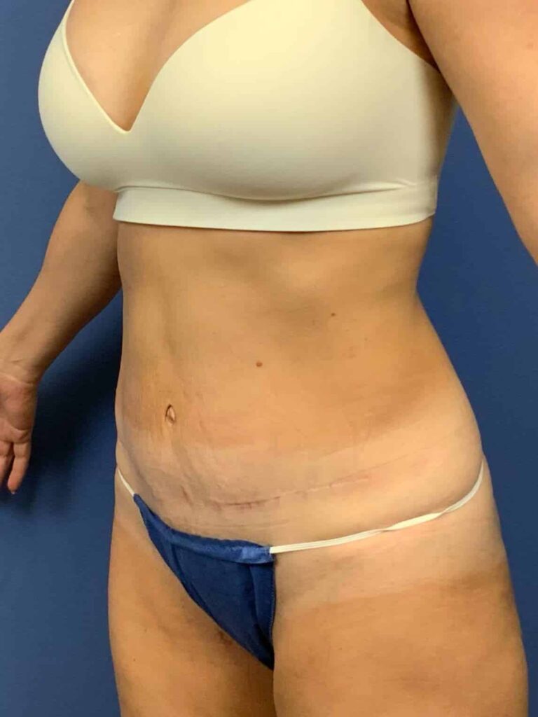 After Image:  - left-front-oblique