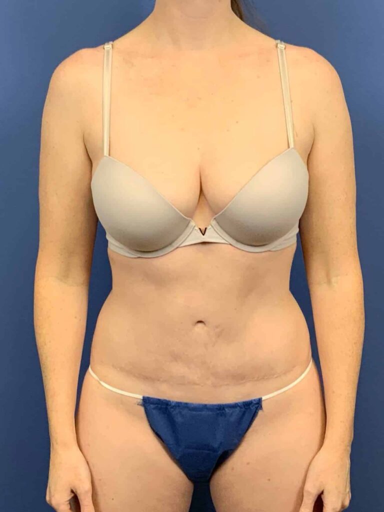 After Image:  - front