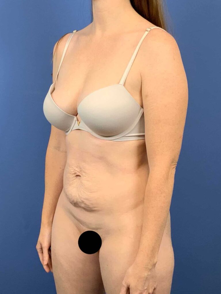 Before Image:  - left-front-oblique