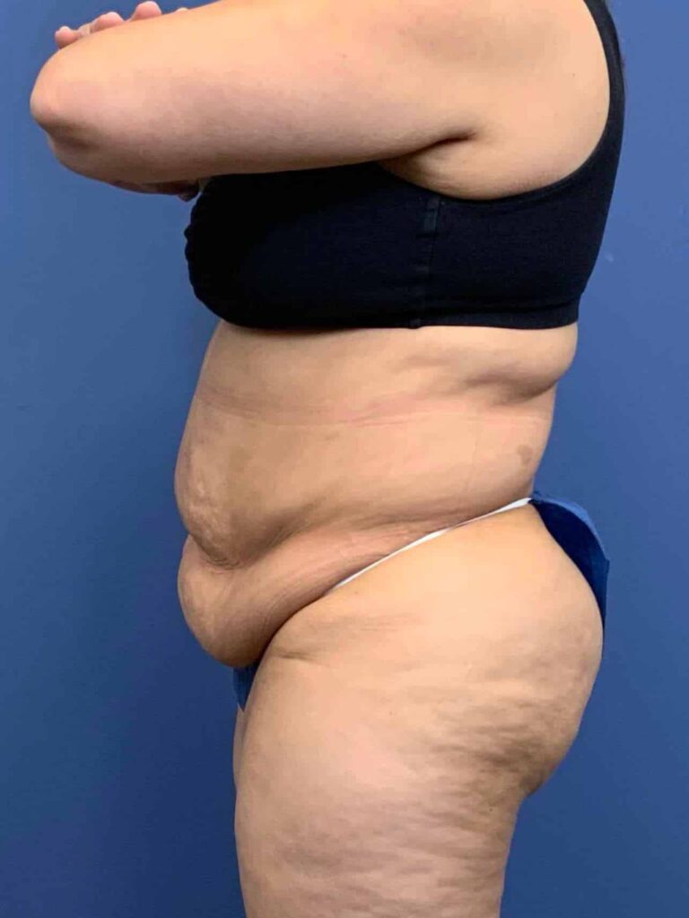 Before Image:  - left-side