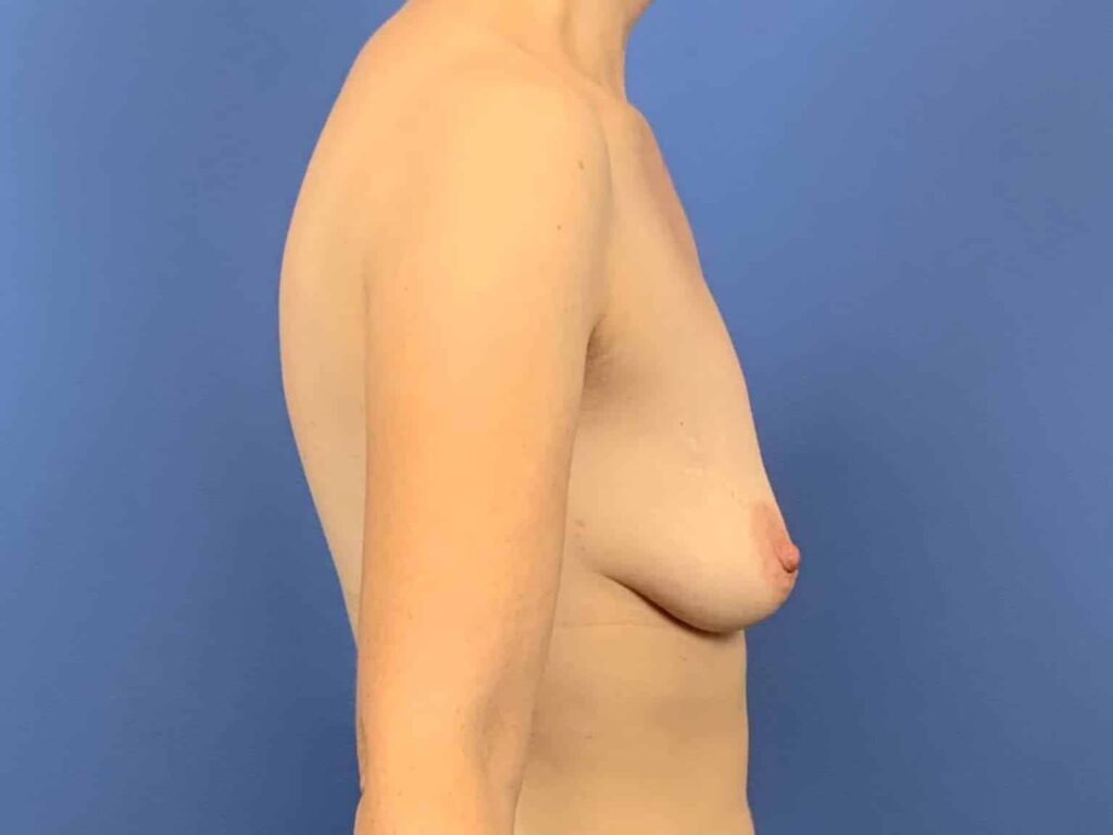 Before Image:  - right-side