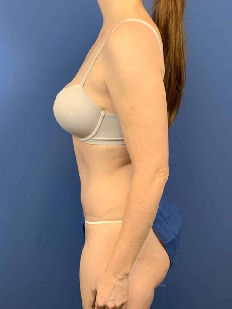 After Image:  - left-side