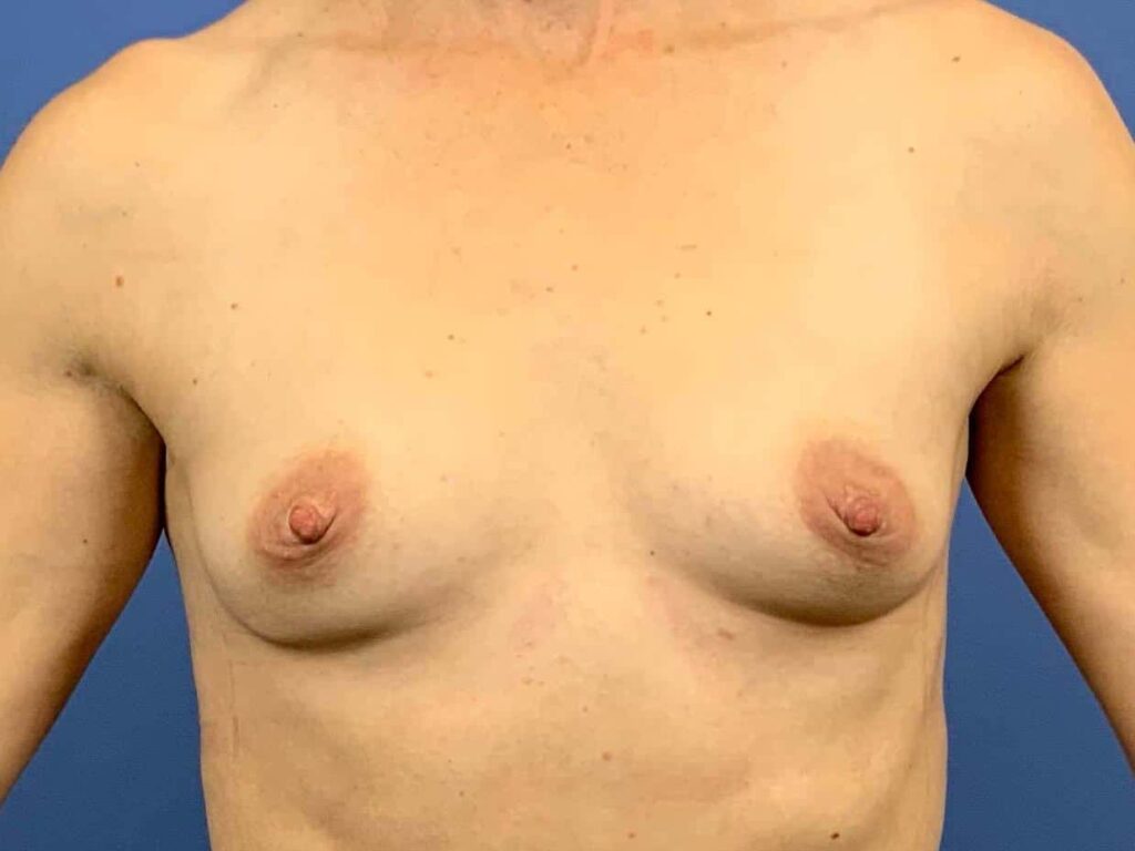 Before Image:  - front