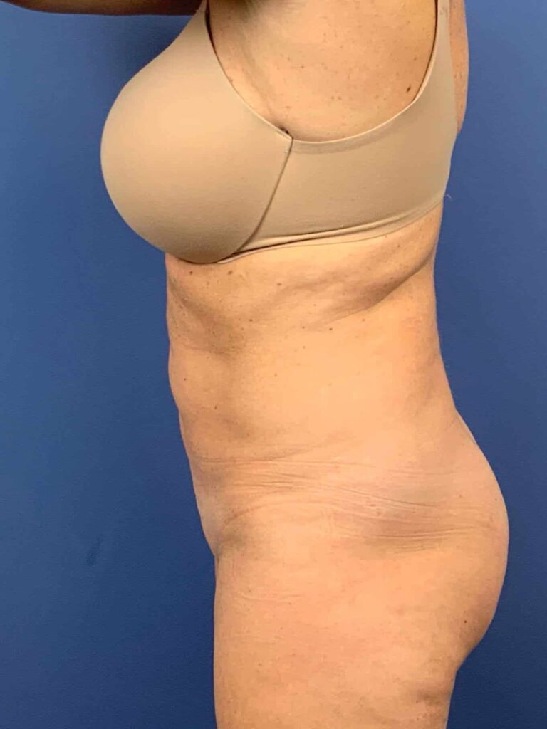 Before Image:  - left-side