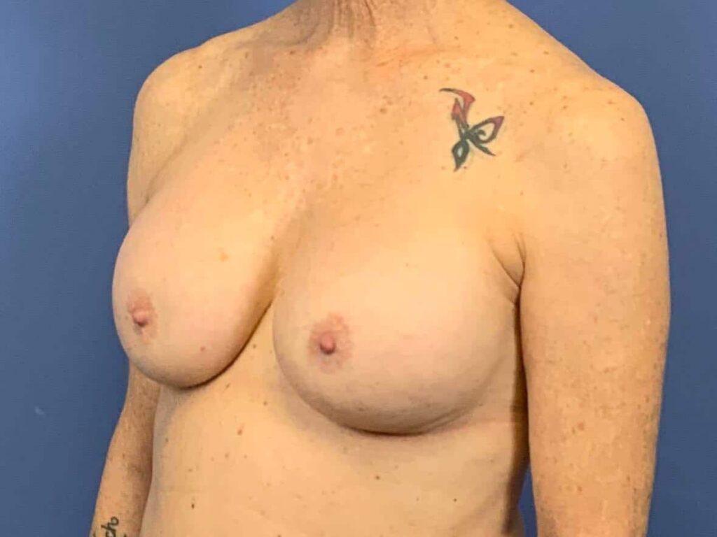 After Image:  - left-front-oblique