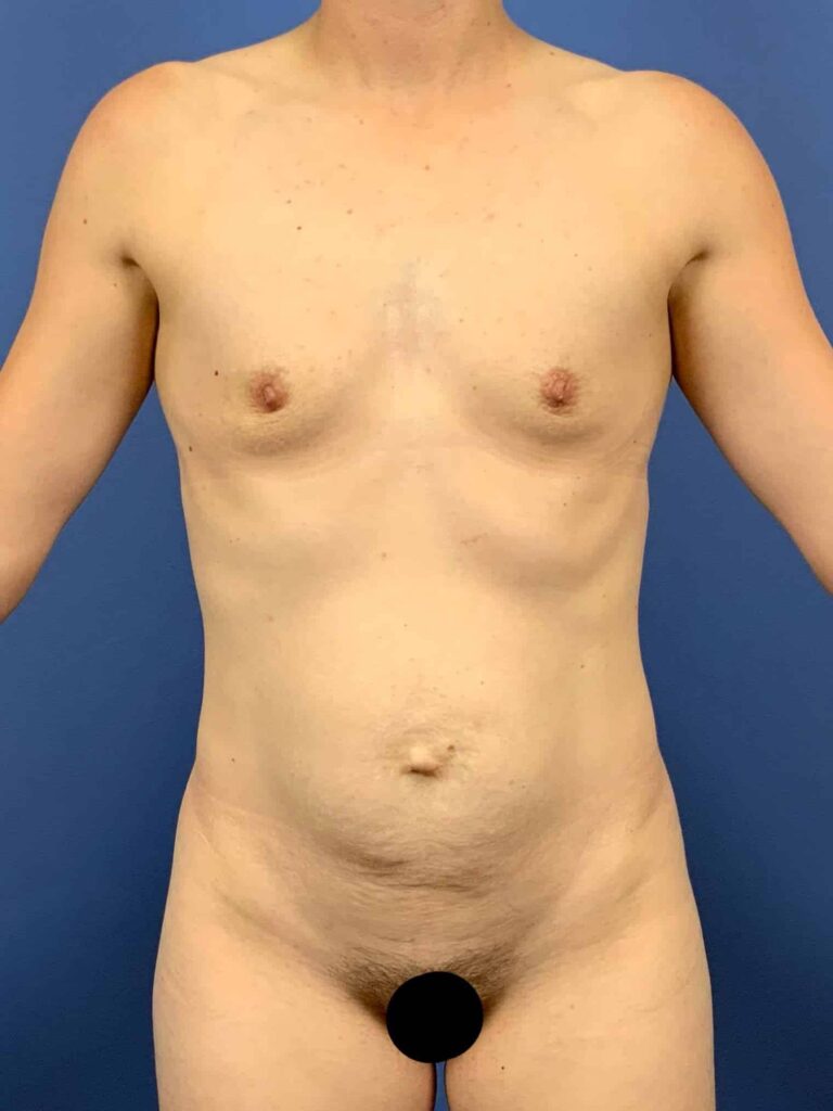 Before Image:  - front