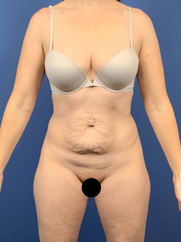 Before Image:  - front