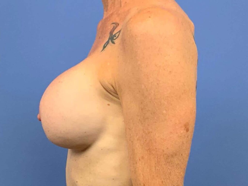 Before Image:  - left-side
