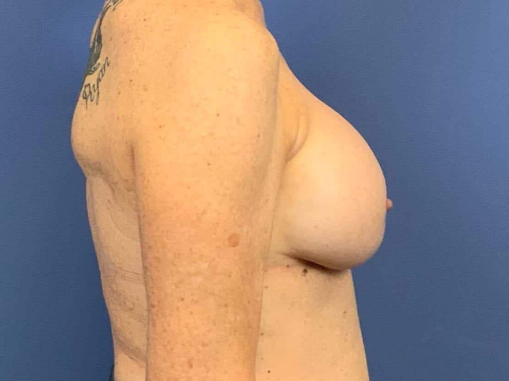 After Image:  - right-side