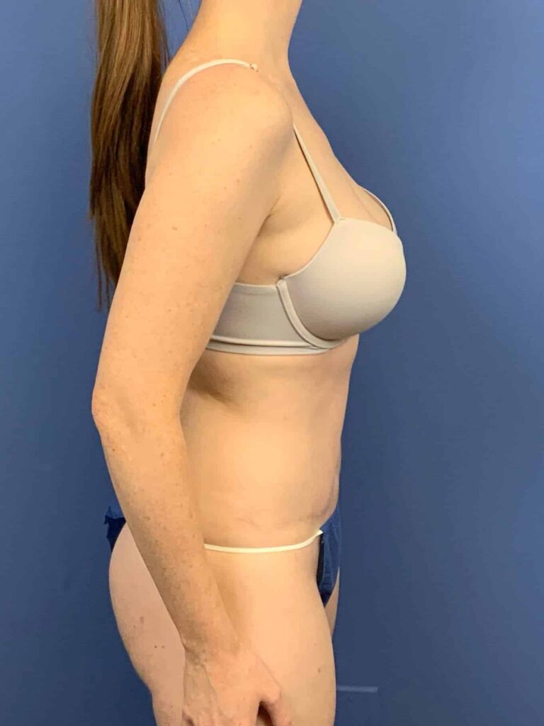 After Image:  - right-side