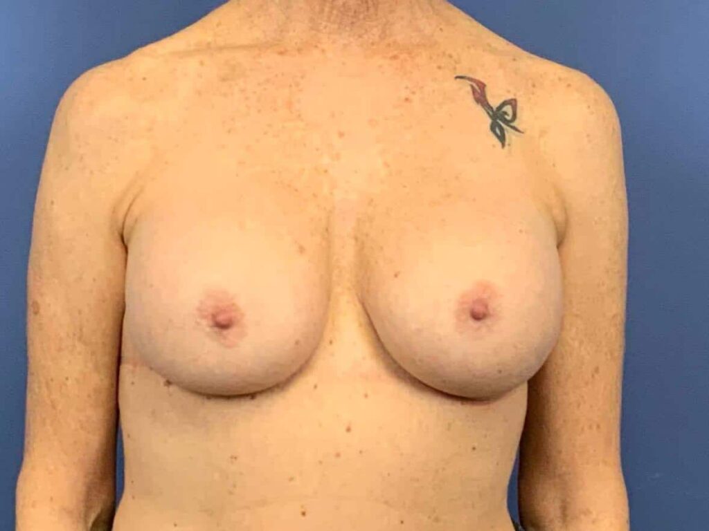 After Image:  - front