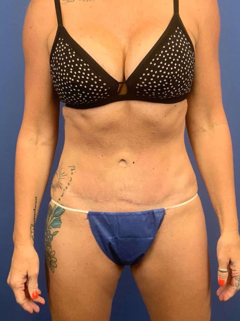 After Image:  - front