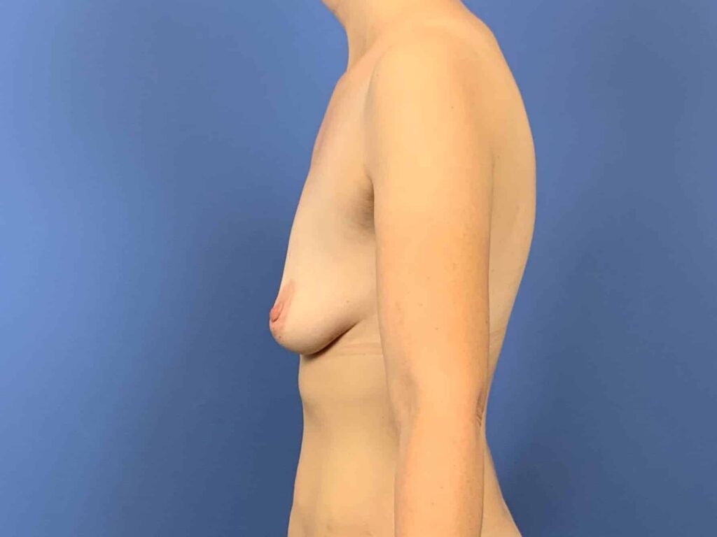 Before Image:  - left-side