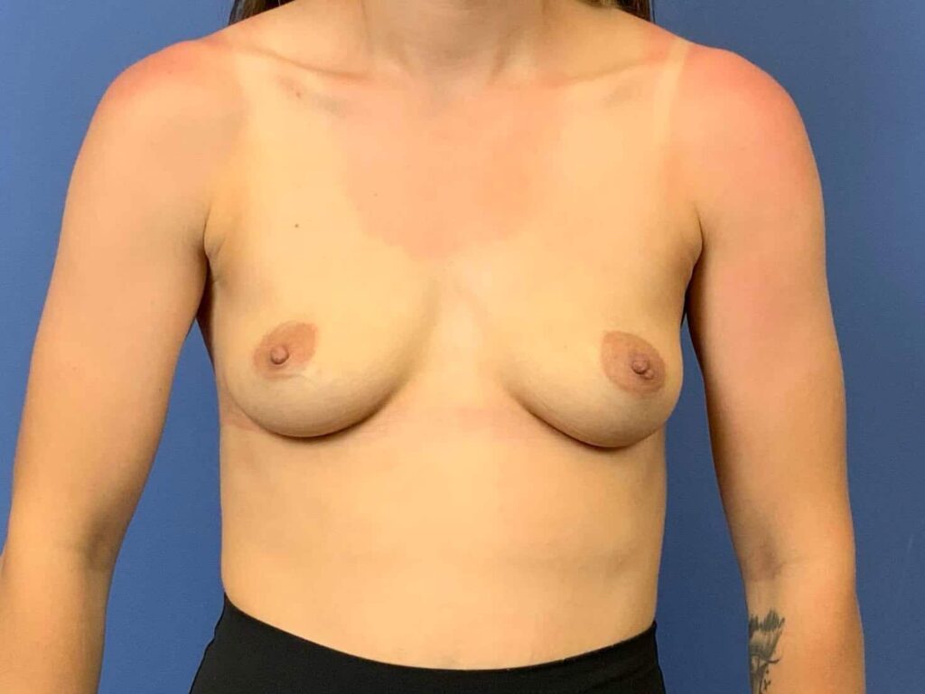 Before Image:  - front