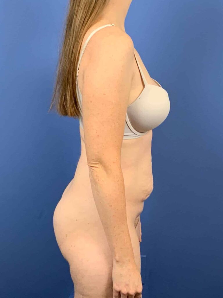 Before Image:  - right-side