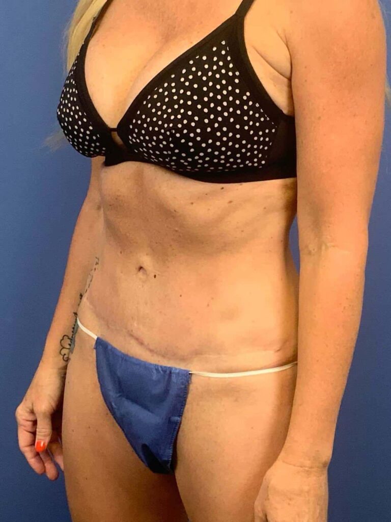 After Image:  - left-front-oblique