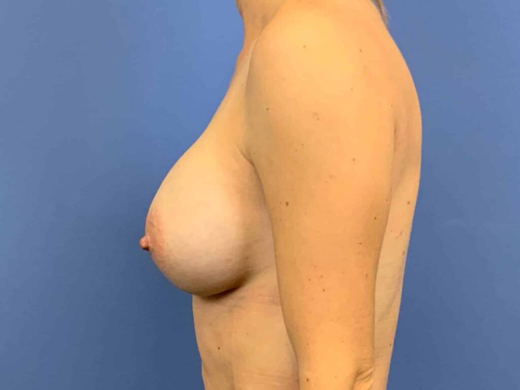 After Image:  - left-side