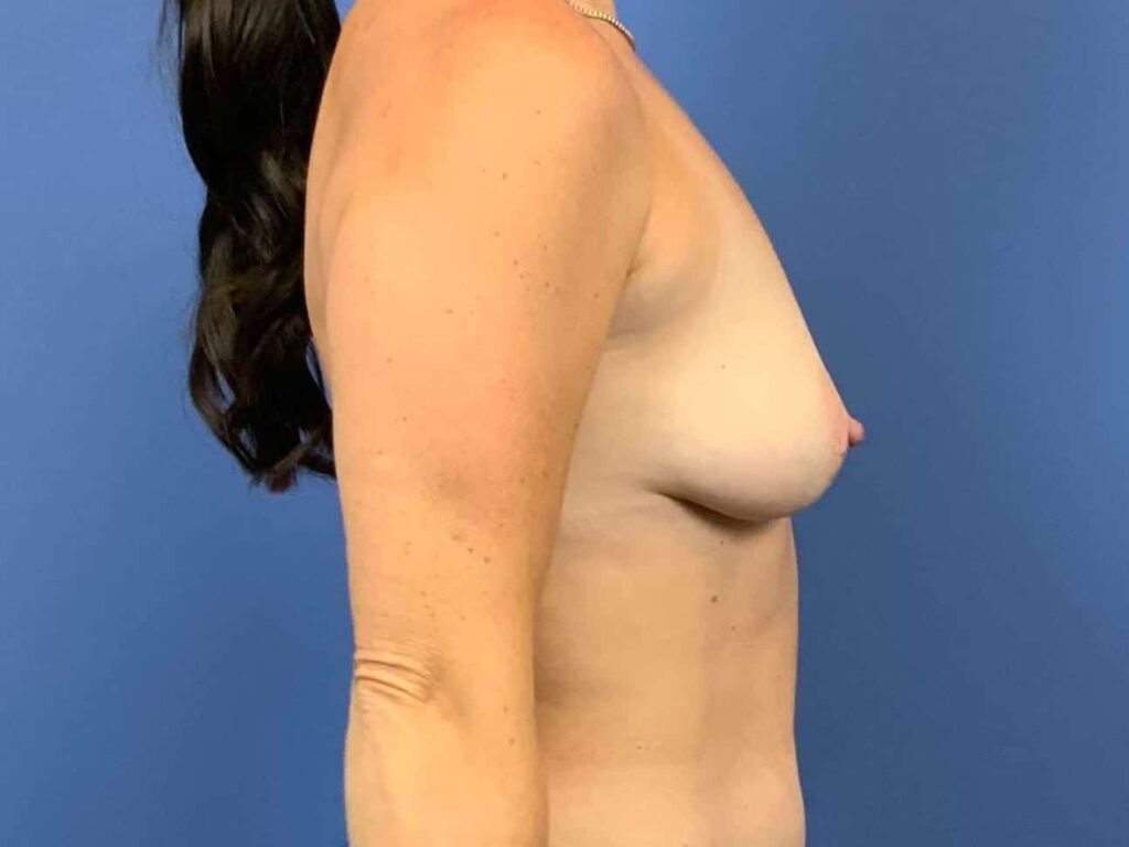 Before Image:  - right-side