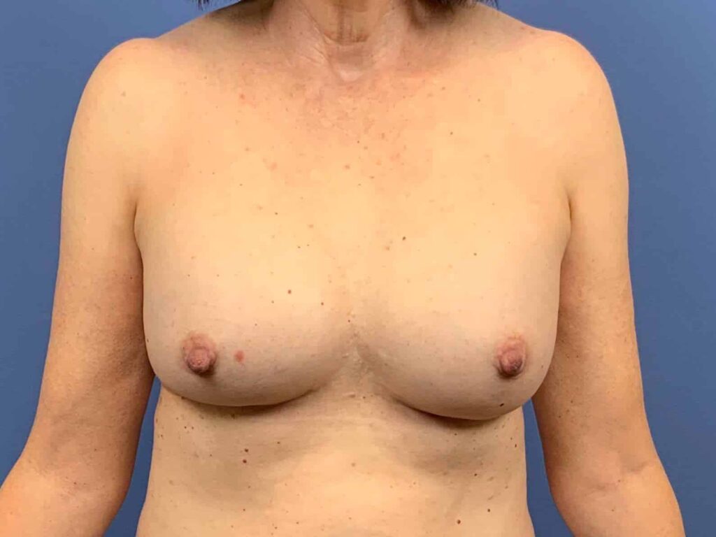 Before Image:  - front