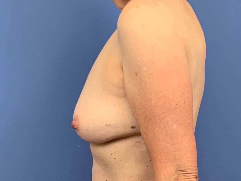 After Image:  - left-side