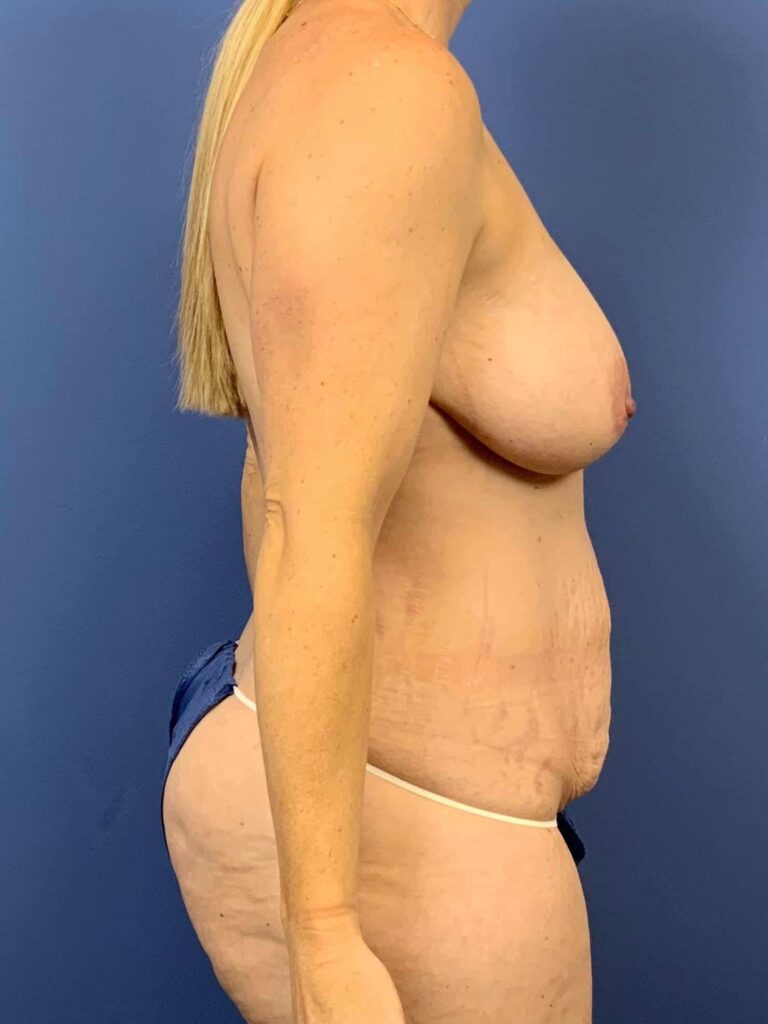Before Image:  - right-side