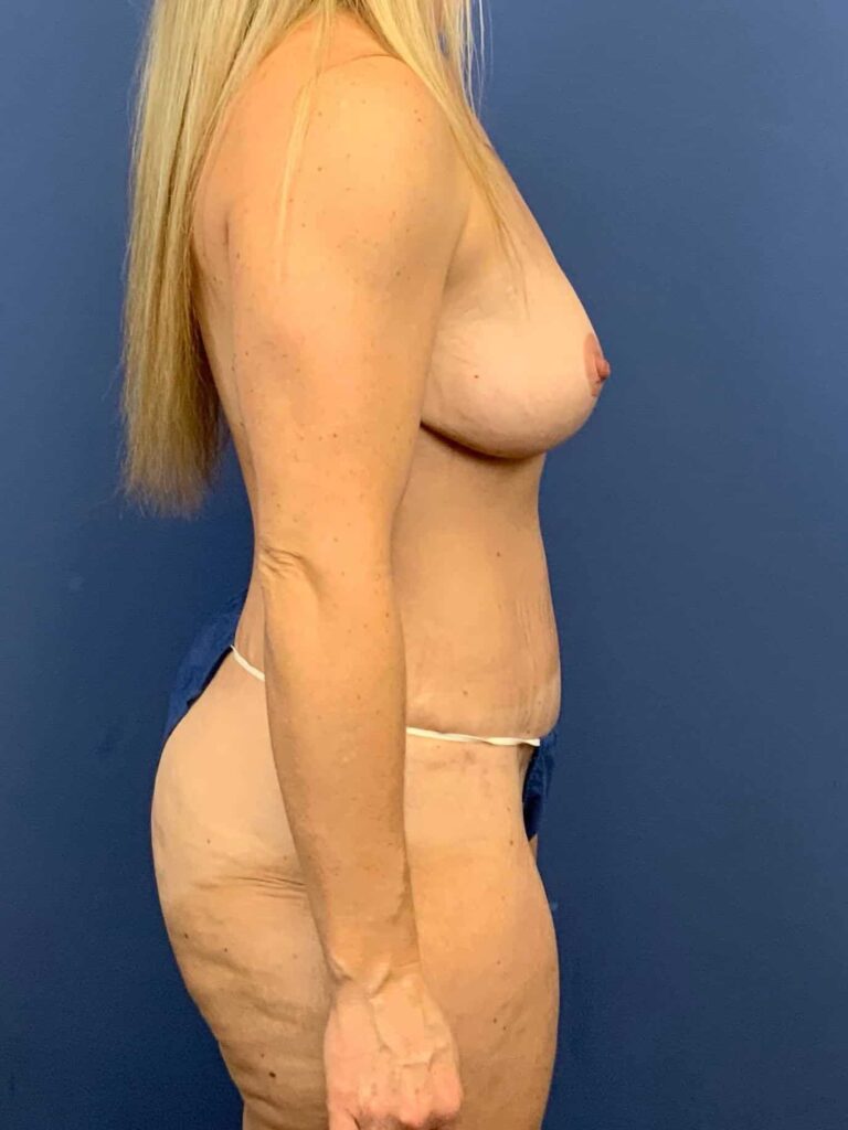 After Image:  - right-side