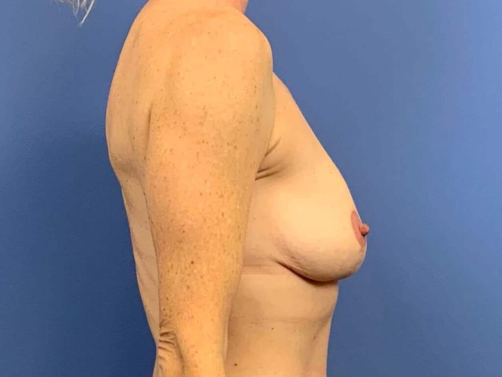 After Image:  - right-side