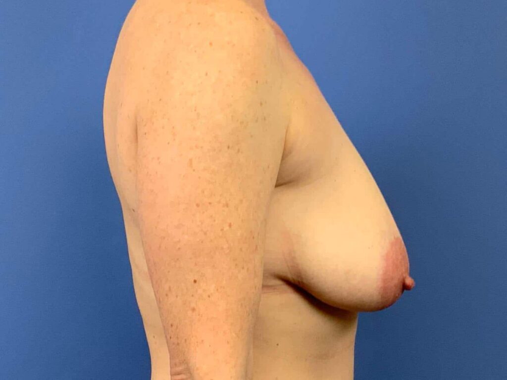 Before Image:  - right-side