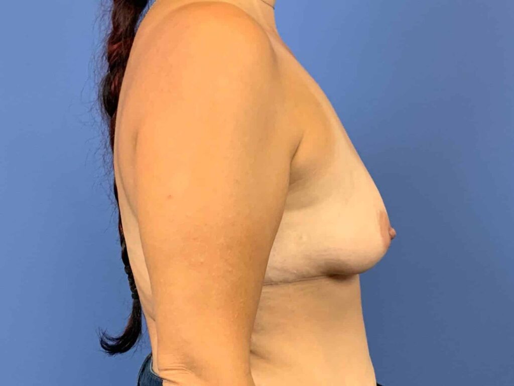 Before Image:  - right-side