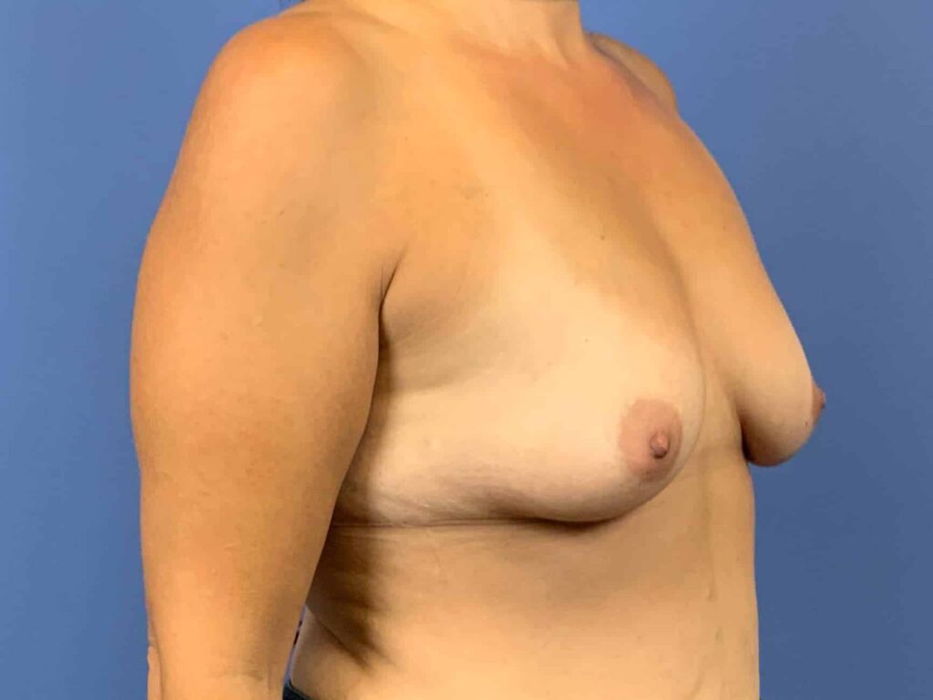 Before Image:  - right-front-oblique