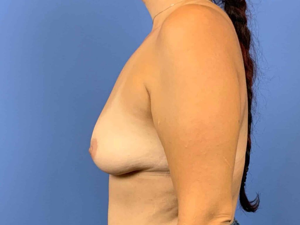 Before Image:  - left-side