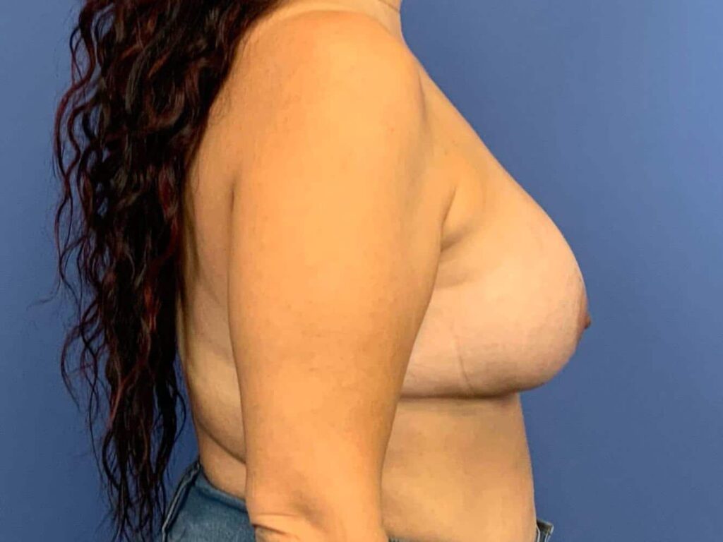 After Image:  - right-side