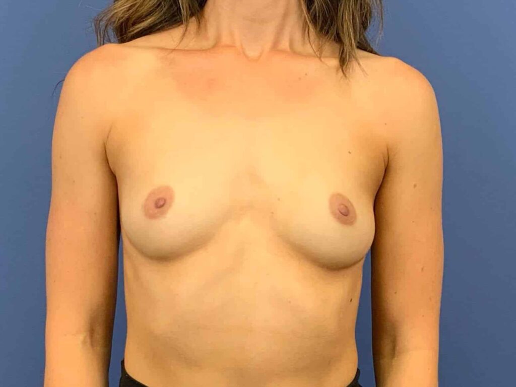 Before Image:  - front
