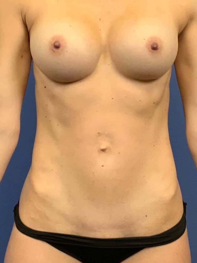 After Image:  - front
