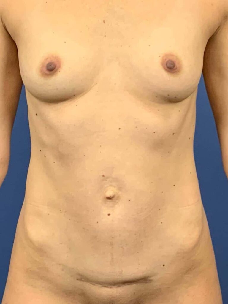 Before Image:  - front