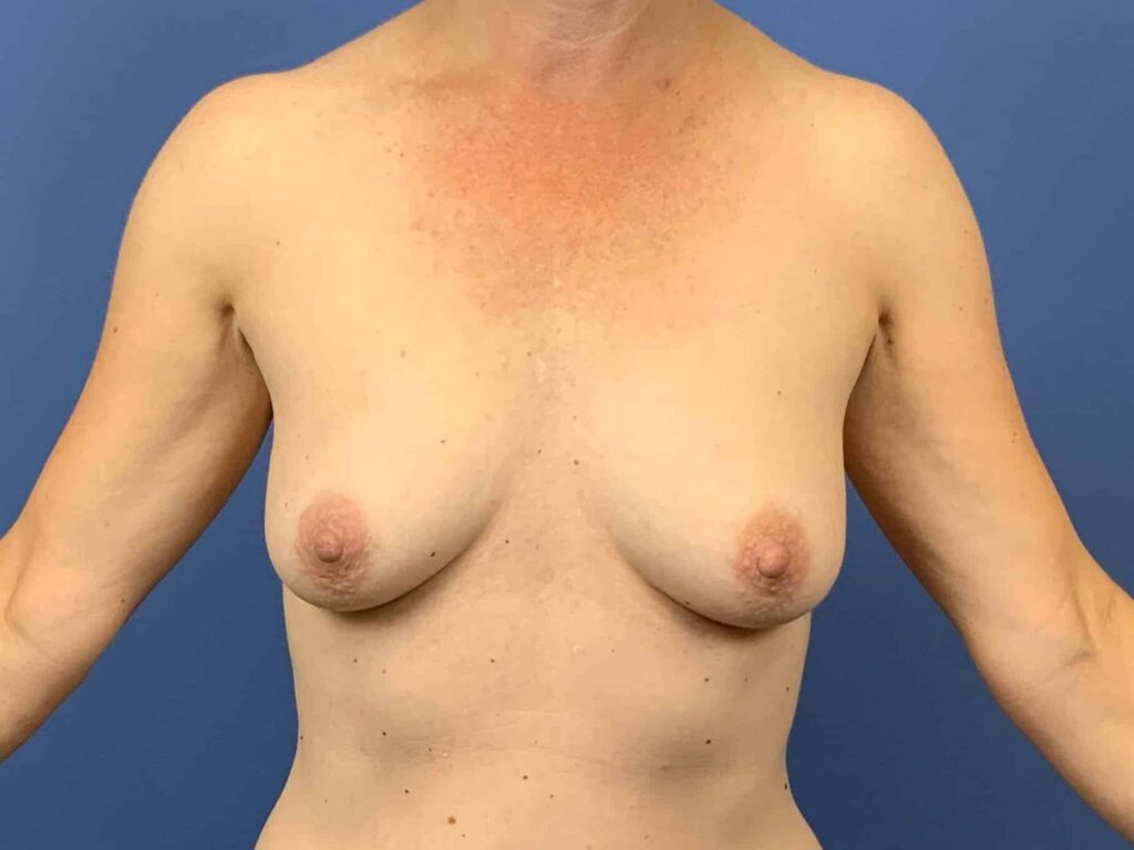 Before Image:  - front